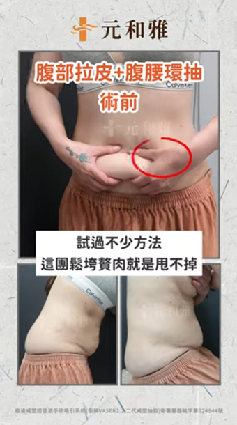 元和雅複合式腹部拉皮 | 找回的不只是腰身還有自信❤️ #元和雅 #推薦 #質感醫美 #大熱門 #元和雅 #腹部拉皮 #抽脂手術