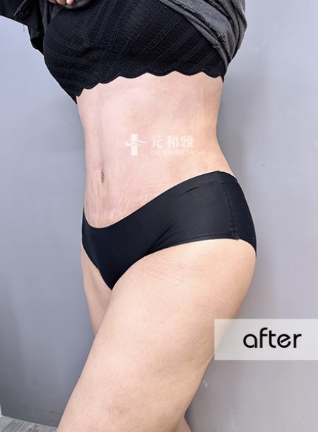 Abdominal Curve Reshaping + Abdominal Waist Circumference Case | Improve Belly Fat, Create a Sleek Girl's Waist