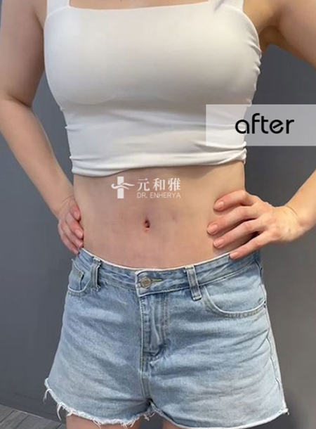 Abdominal tightening adjustments make aunties become sisters, banish the thick waist monster.