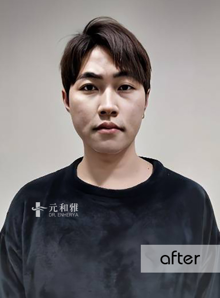 天鵝頸拉提:從雙下巴困擾到俐落下顎線大變身