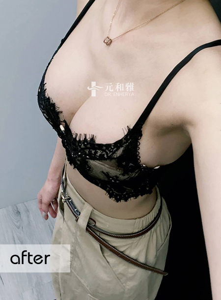 Pearl Bolong Breast Surgery: Unlocking Curvy Hotness, Even Basic Lingerie Can Exude Sophistication