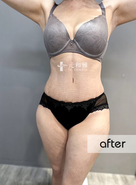 Complete Record of Abdominal Tightening Reconstruction | The Entire Journey from Loose Abdomen to Firm and Flat