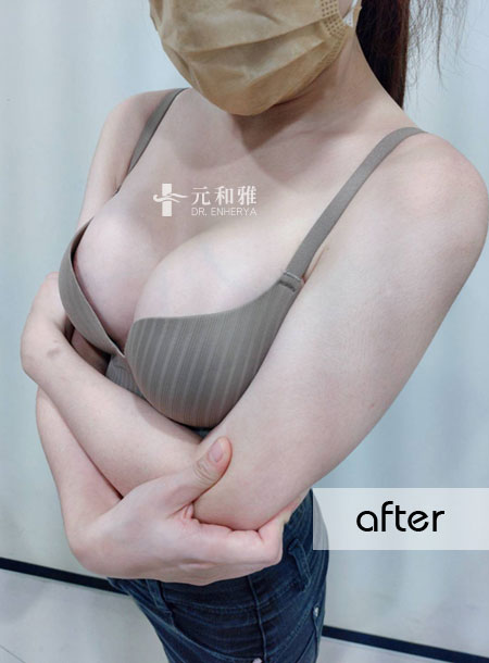 珍珠波隆乳手術，小隻女的逆襲～終於不用靠水餃墊撐場面！