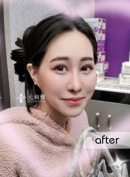 [Chin Surgery Comprehensive Cases] Professional chin shaping, the best choice for creating a three-dimensional facial shape.
