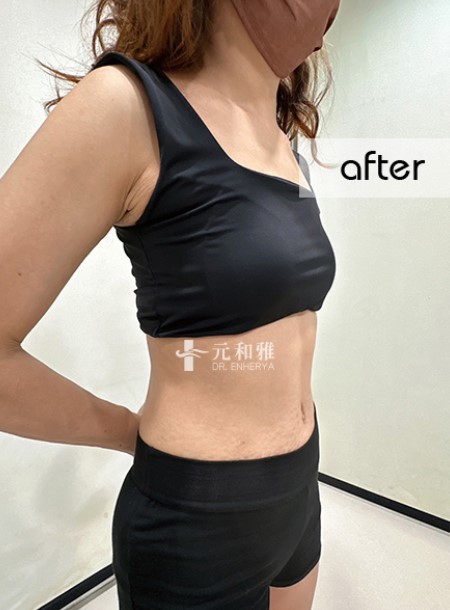 Multi-layered abdominal lift experience, witnessing my neighbor transform into a hot mom! Enherya's "multi-layered abdominal lift" helped me shed my aunt-level huge belly.