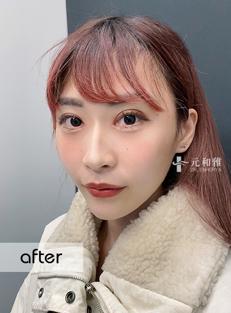[Comprehensive Cases of Eye Bag Surgery] Eye bag removal surgery, a solution to bid farewell to tired eyes.
