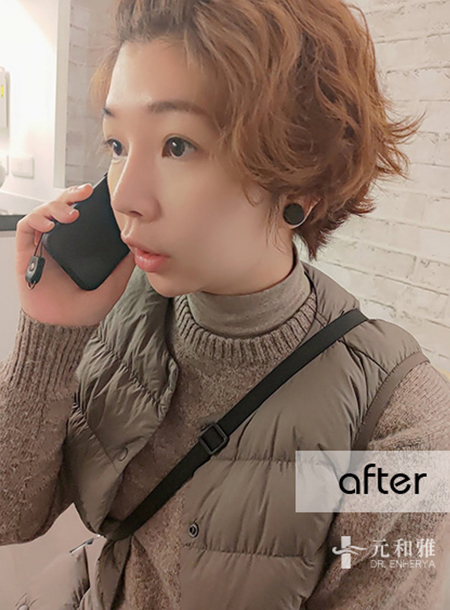 Half-rib nose surgery can also bring a spring to a fleshy nose! Transforming a flat face to enhance confident appearance.