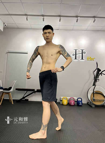 Tainan flat chest surgery fiercely eliminates bulging, boldly stepping onto the dream bodybuilding stage.