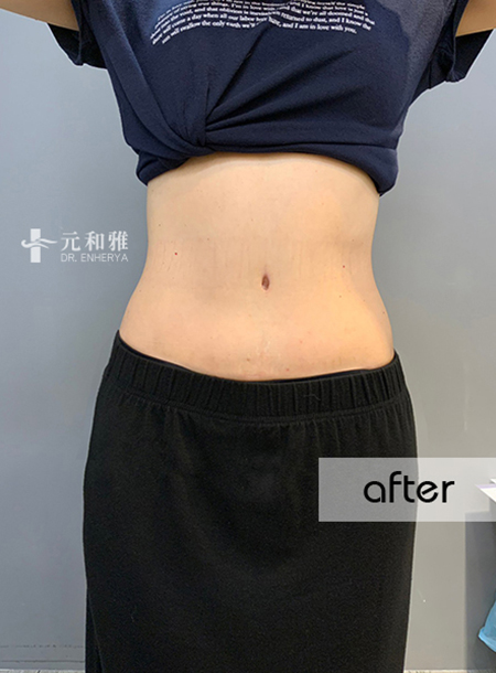 Taipei Abdominal Reshaping + Circumferential Liposuction Case | Postpartum Moms Brave to Pursue Beauty, Regain Their Smiling Self