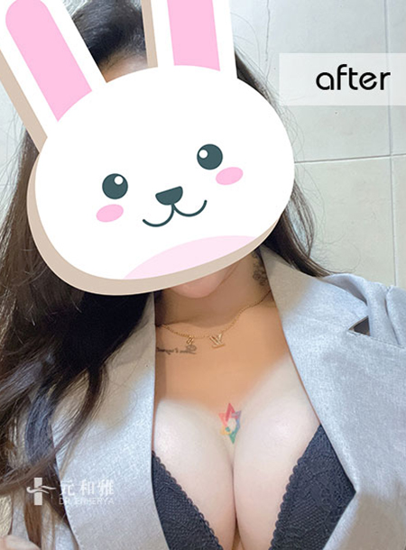 Let you also have the droplet feeling of a goddess wave! Taipei Magic Droplet breast augmentation allows even a paper-thin woman to have goddess waves.