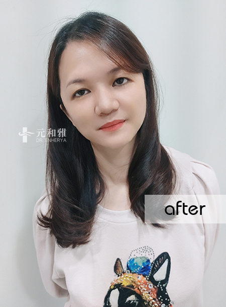 Hidden Scar Fascia Lifting Surgery: Gracefully tightens and allows time to quietly rewind, effortlessly preserving youth.