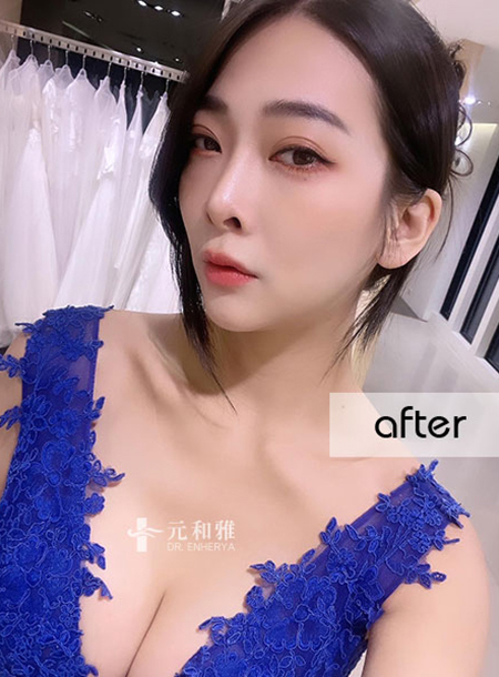 Internet celebrity breast augmentation case | Pure desire type E-cup internet celebrity Orange, a magical drop, second generation unparalleled good wave JOY 2.0 breast augmentation new realm