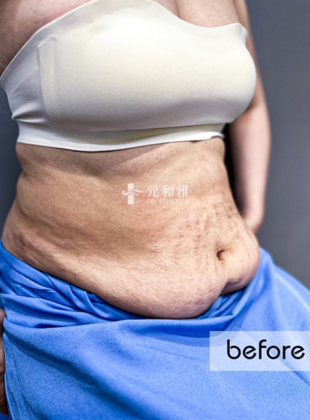 Postpartum abdominal tightening case allows her to enjoy a soak and show off her abs after giving birth, feeling smooth and firm.