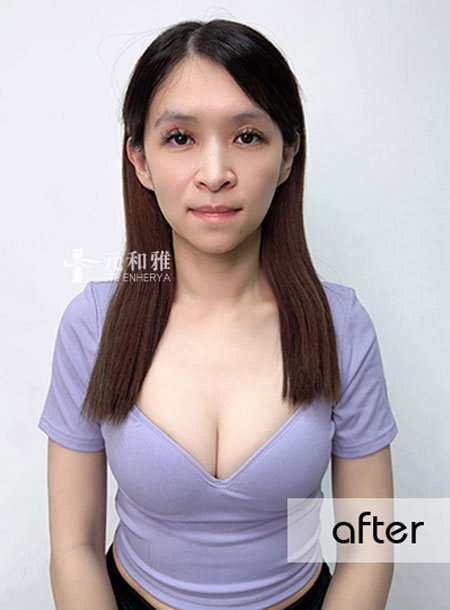 Hidden Scar Fascia Lifting: A Face Transformation Technique During Lunch Break, Turning a Tired Office Worker into an Exquisite Beauty in 20 Minutes.