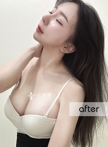 Magic Drop 2nd Generation Magic Drop JOY Enherya Fang Fang Nurse's Breast Augmentation Experience Sharing