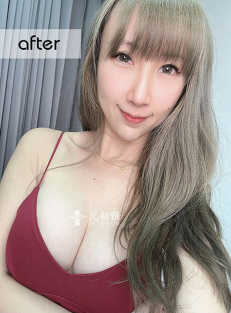 Pin Ying Second Breast Augmentation Magic Drip 2.0 Upgrades Beautiful Breasts Again