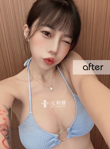 Magic Drip 2.0 Magic Drip Second Generation Breast Augmentation Surgery Defeats Empty Cup Shrinkage Milk