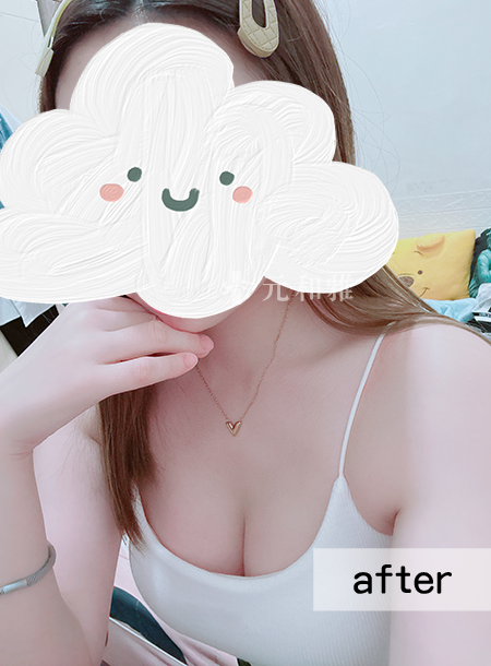 珍珠波隆乳心得》告別飛機場！台南元和雅打造高CP值Q彈美胸（小A變D罩杯）