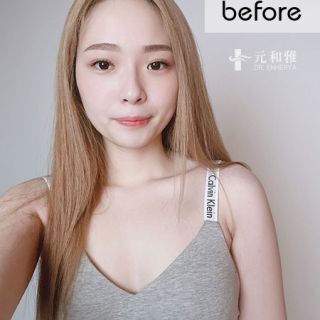 台南女王波隆乳診所