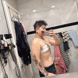 平胸手術, 平胸台灣經驗, 海外平胸手術