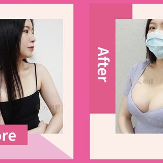 魔滴隆乳2.0案例