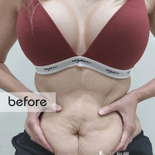 高雄腹部拉皮手術