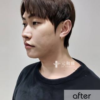 天鵝頸拉提手術心得