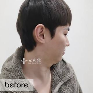 天鵝頸拉提手術價格