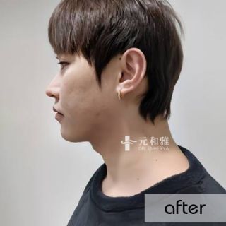 頸部拉皮