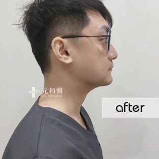 天鵝頸拉提, 輪廓線拉提, 小V臉拉提