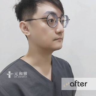 輪廓線拉提, 小V臉拉提, 緊緻下顎線
