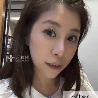 小V臉拉提