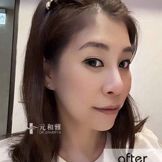 小V臉拉提