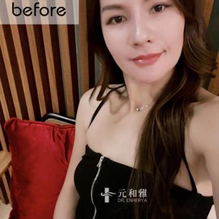 女王波適合對象, 隆乳經驗談