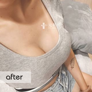 女王波適合對象, 隆乳經驗談