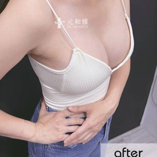 盈波隆乳