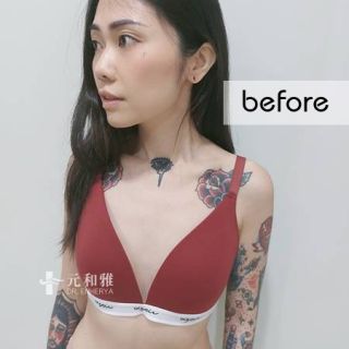 珍珠波隆乳效果