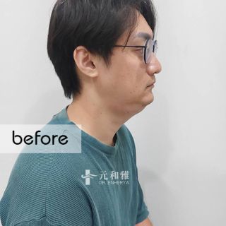 天鵝頸拉提術前