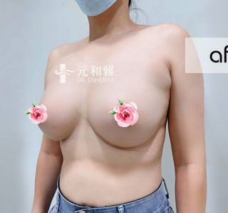 隆乳媽媽日常