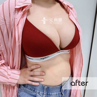 隆乳材質選擇比較