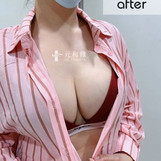 A罩杯變E罩杯經驗