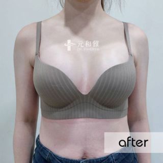 隆乳經驗分享