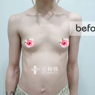 高雄珍珠波隆乳