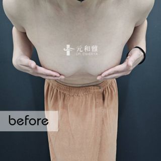 魔滴隆乳案例, 自然隆乳推薦