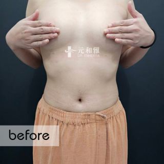 魔滴2.0, 魔滴隆乳, 隆乳真實分享, 飛機場隆乳
