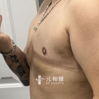 台灣平胸醫師, 束胸不適, 平胸真實分享