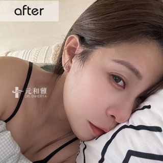 小V臉拉提