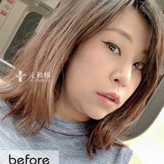 緊緻下顎線
