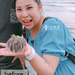 小V臉拉提