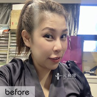 天鵝頸拉提案例